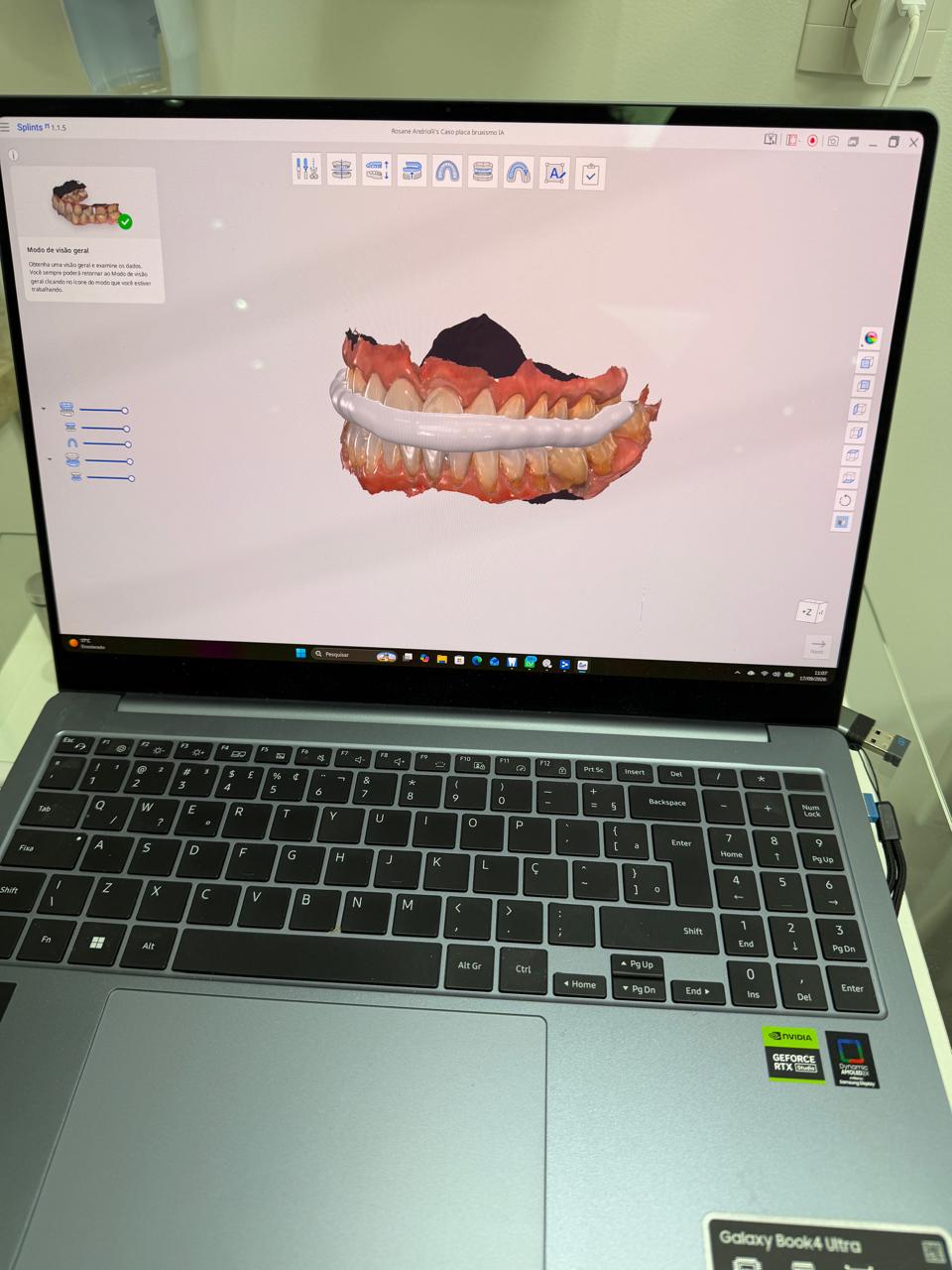 Planejamento digital 3D de prótese protocolo em computador