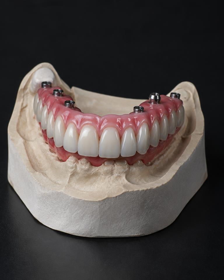 Prótese protocolo sobre modelo de gesso em laboratório