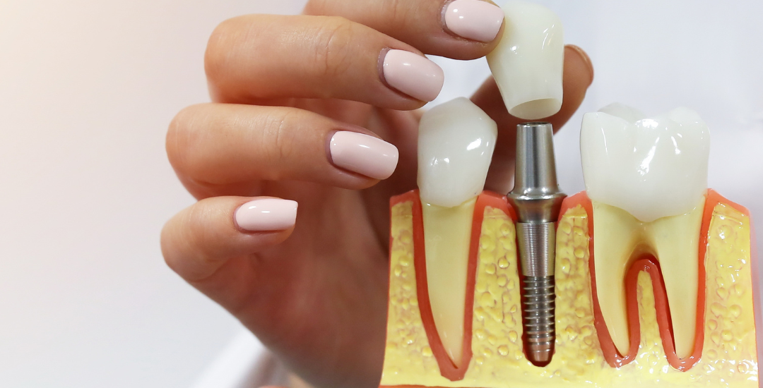 Benefícios dos Implantes Dentários