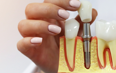 Benefícios dos Implantes Dentários