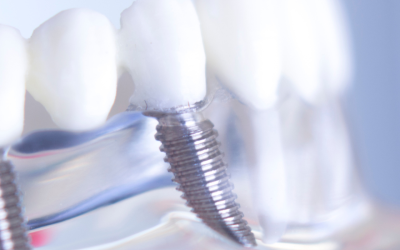 Colocação de implantes dentários