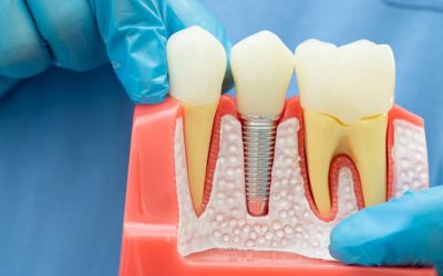 Guia Completo sobre Tipos de Implantes Dentários: Expertise da Clínica Dal Pizzol em São Leopoldo
